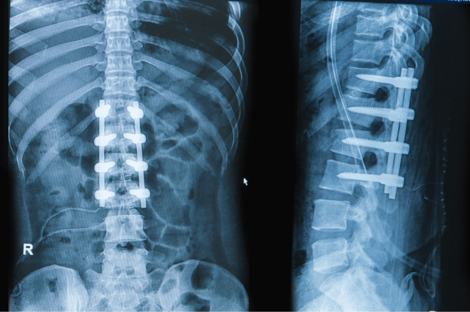 X-ray showing two views of a spinal fusion that was done using hardware manufactured at TOMZ Corporation.